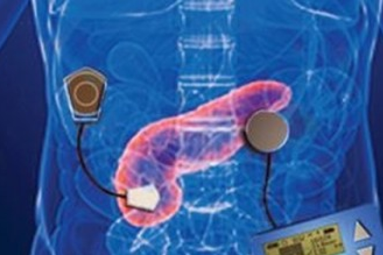 A mesterséges hasnyálmirigy lehet a cukorbetegek megmentője