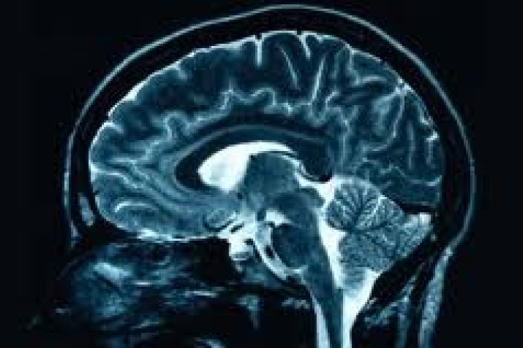 Agysejtek adnak betekintést a Down-Szindrómába