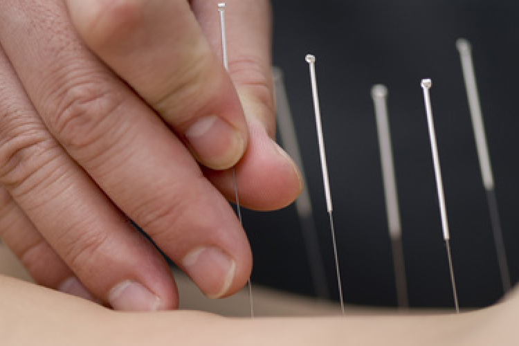 Valóban hatásos az akupunktúra